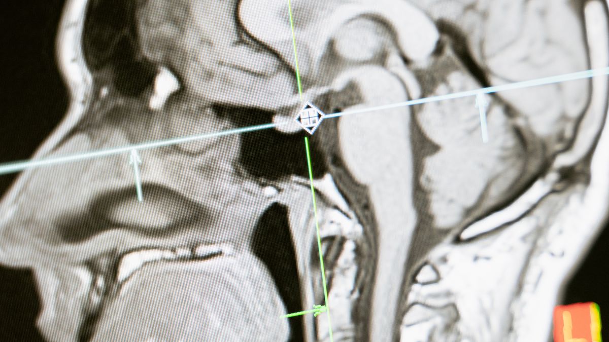 Multiple Sclerosis (MS) – Dihexa evidence review