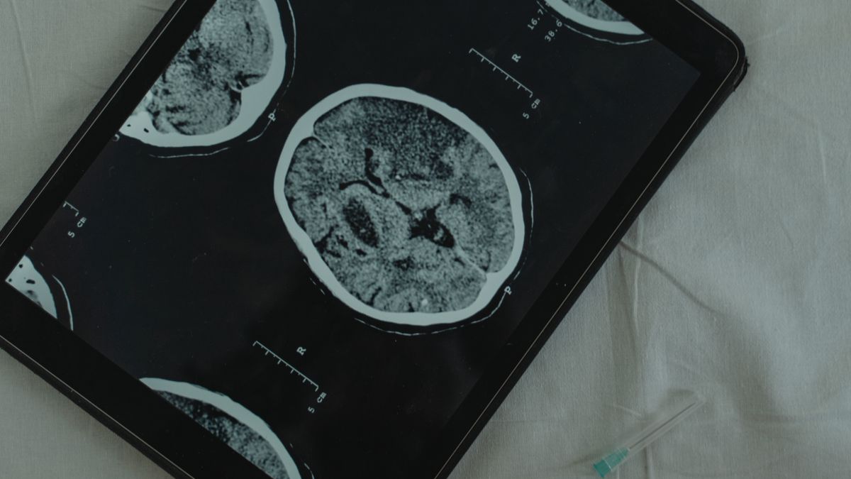 TBI, Concussion and Stroke Recovery – Dihexa evidence review